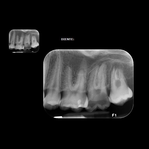 Radiografía periapical: